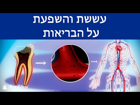 © עששת והשפעת על הבריאות