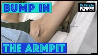 Get Rid of this BUMP in my Armpit!!