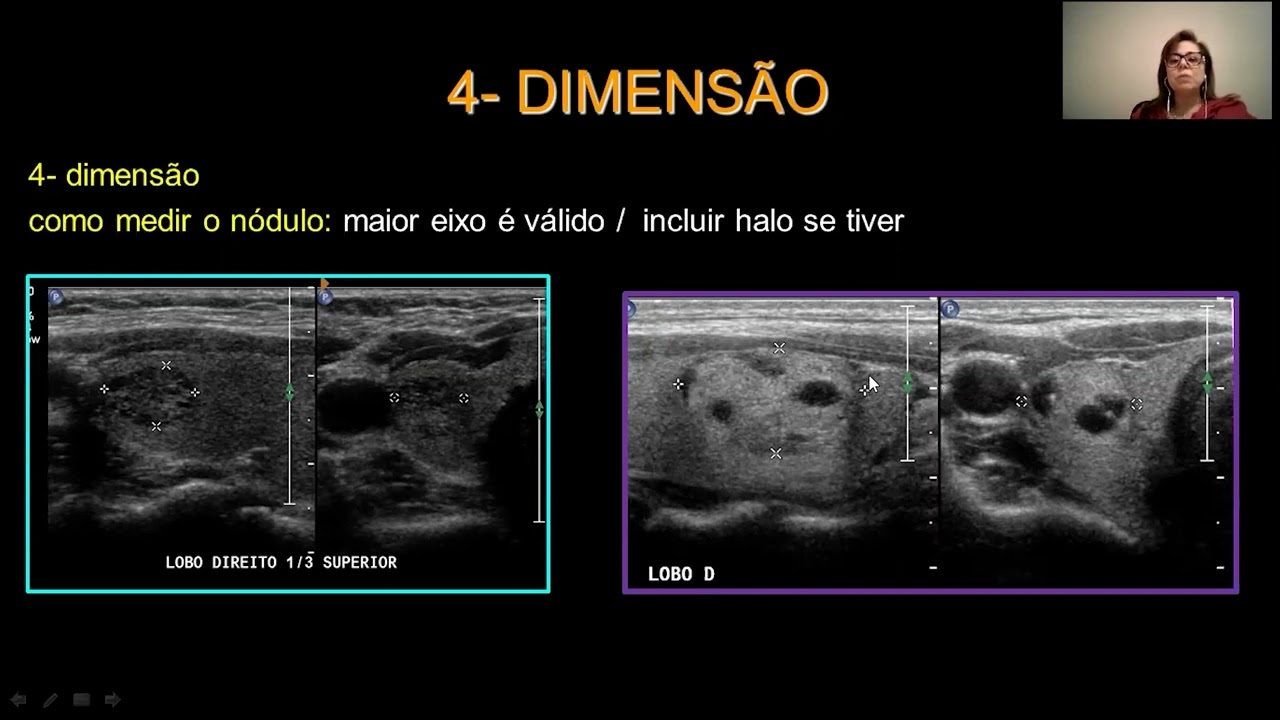 Avaliação Ultrassonográfica dos Nódulos da Tireoide