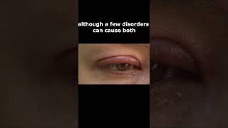 Symptoms of Eye Disorders - Eyelid Swelling
