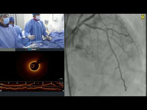 Staged PCI of Calcified LAD-D1 Bifurcation using IVL + Rota with OCT Imaging
