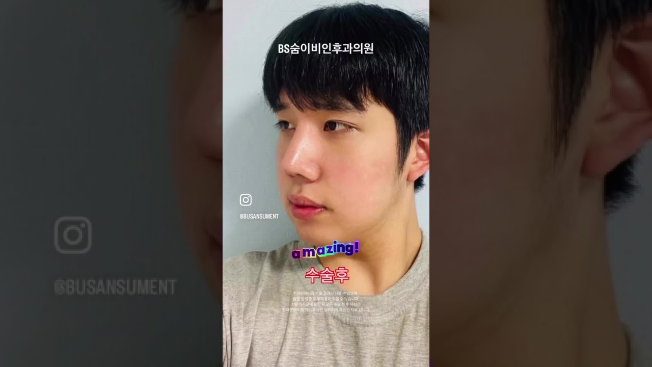 군 복무 일정 고려해%%무리 없이 가능한 기능+미용 성형!👃🏻