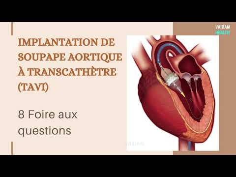 IMPLANTATION DE SOUPAPE AORTIQUE À TRANSCATHÈTRE (TAVI)