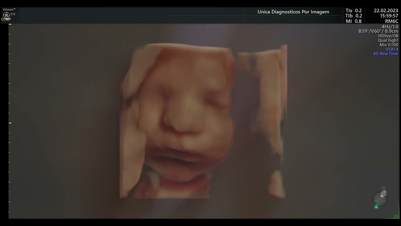 Ultrassom 4D HD LIVE ou Ultrassom 5D - 2