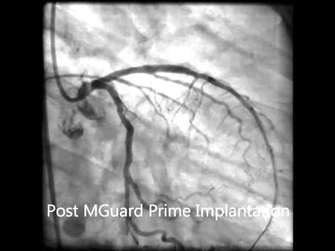 Dr. Almagor: MGuard Prime™ OFDI Insights STEMI