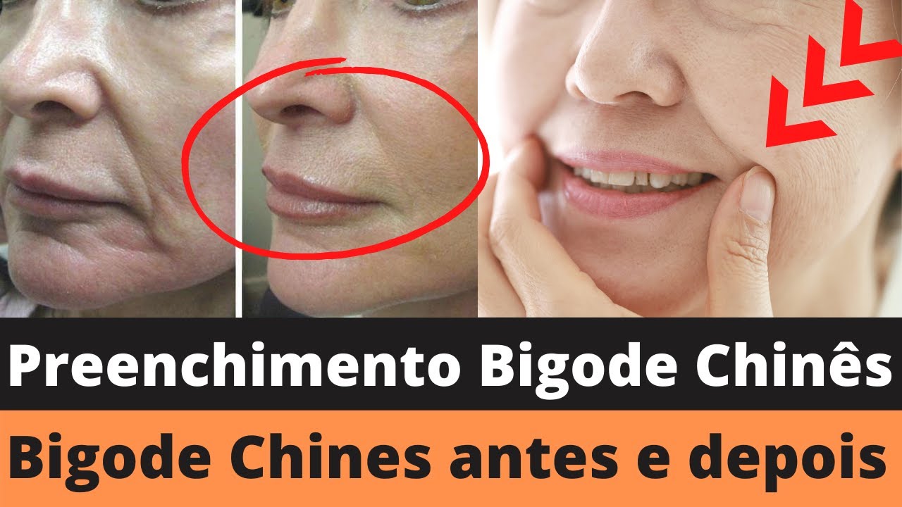 Bigode chinês antes e depois preenchimento bigode chinês