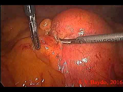 Laparoscopic Excision Biopsy of Mesenteric Liposarcoma 