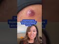 Dr Pimple Popper Reacts to Inflamed Cyst! #shorts #drpimplepopper