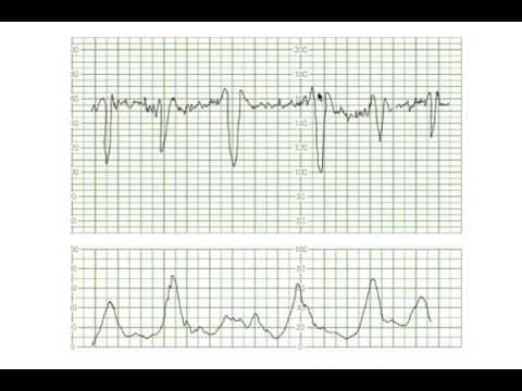 Decelerations Uncomplic Variables