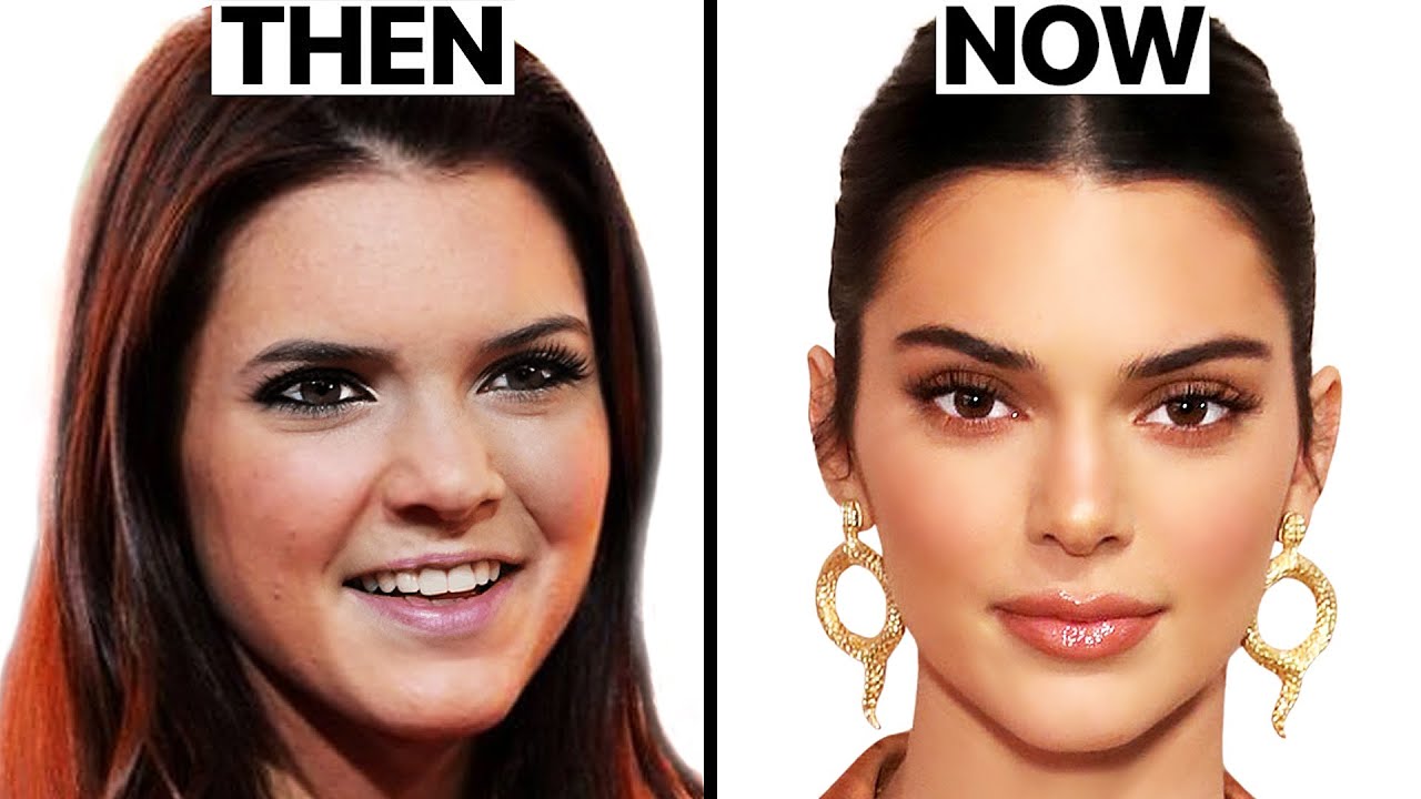 What Happened to Kendall Jenner's Face? | Plastic Surgery Analysis