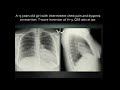 Chest Radiographic Findings You Don T Want To Miss
