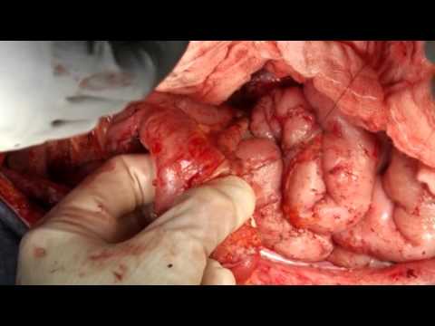 Tratamiento papiloma virus genital