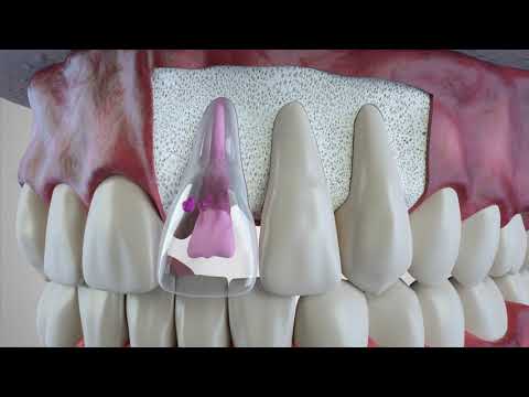 Types of Tooth Resorption