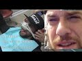L A BEAST AFTER DENTIST LASER EYE SURGERY