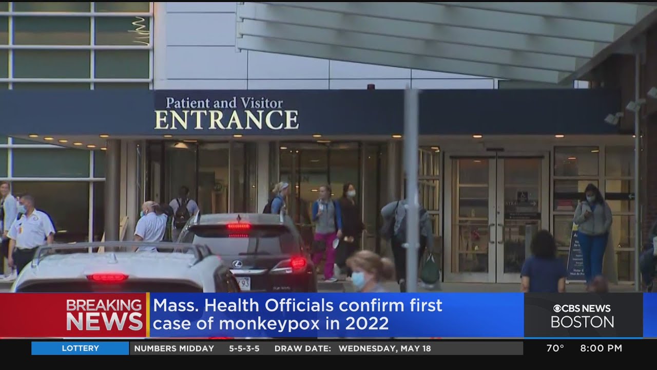 Monkeypox confirmed in Massachusetts; first US case identified in 2022