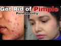 How To Get Rid Of Pimples Permanently In 7 Days Skincare Pimples Acnetreatment