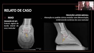 #23 "FRATURA DE NAVICULAR ASSOCIADO À SÍNDROME PODOTROCLEAR EM EQUINO DA RAÇA QUARTO DE MILHA"