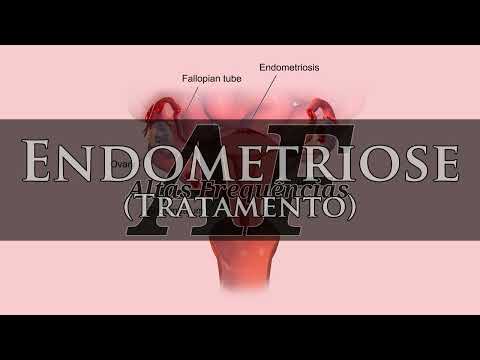 Endometriose (tratamento) | Canal: Altas Frequências