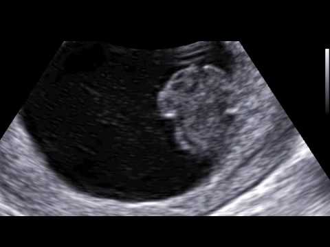 ACRANIA/ Anencephaly transverse section  suspected at 9 WEEKS