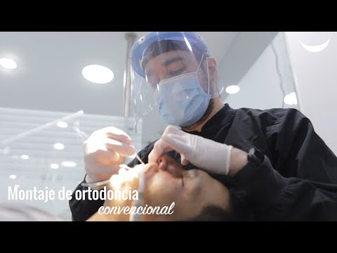 Montaje de ortodoncia convencional