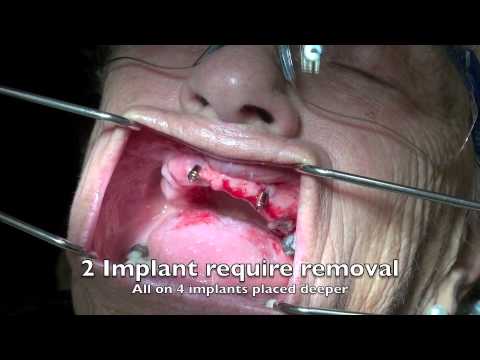 How to remove a dental implant - 3 cases