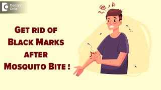 MOSQUITO BITE MARKS | How to treat black marks after mosquito bite?-Dr. Nischal K  | Doctors