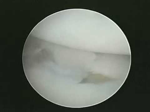 Arthroscopic Exam of Scaphoid Proximal Pole Non-Union