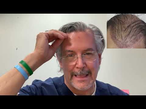 The most challenging hair restoration cases FLAP failure and RADIATION hair loss restoration thumbnail