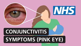 Conjunctivitis: symptoms and treatment for red, itchy, watery eyes | NHS