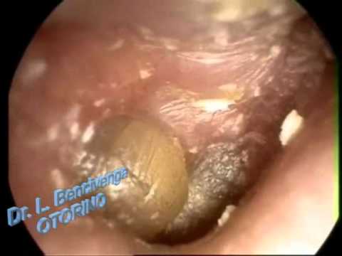 La terapia esercizio terapeutico in osteocondrosi lombare Trattamento della colonna vertebrale materasso ortopedico
