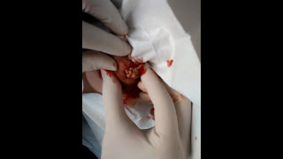 Nipple piercing gone wrong. Turned into abscess.