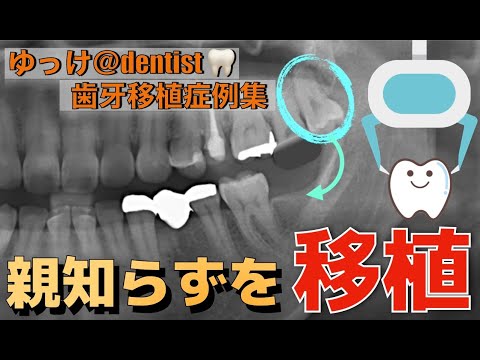 生命歯学科 【歯牙移植症例集】移植は難しいと言われたセカンドオピニオンの患者さん　欠損部分に親知らずを移植🦷再生療法を併用した欠損部に対しての自由診療における歯牙移植を解説🦷保険の移植とココが違う❗️