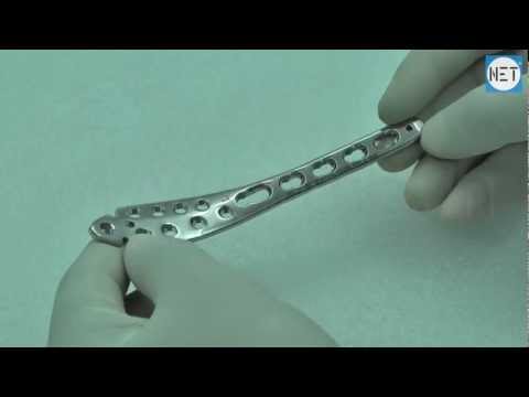 3.5mm Medial Distal Tibia Safety Lock Plate with Tab, SS. Item Code: SF-645.04L to SF-645.14L