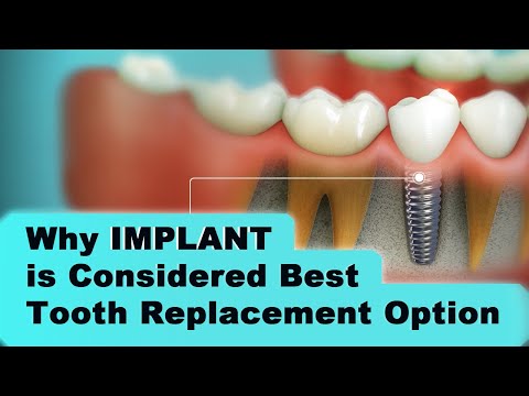 Dental Implant | 3d Medical Animation | Why IMPLANT is Considered Best Tooth Replacement Option