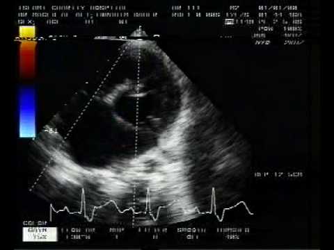Coronary Artery To Left Ventricle Fistula (2/4)