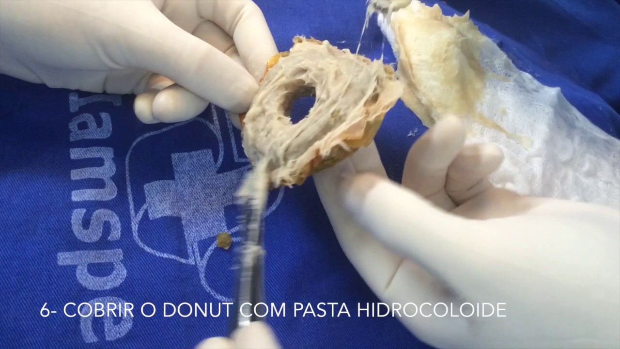Curativo a Vácuo Abdominal com Fístula Entérica