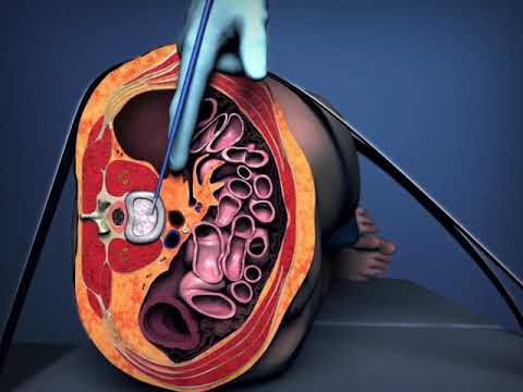 OLIF Procedure Animation
