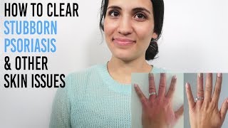 WHAT TO DO IF PSORIASIS IS NOT CLEARING! | Something You&#39;re Missing