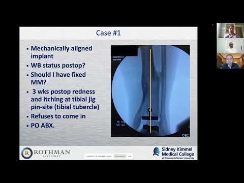 Resurrecting Failed Ankles: Strategies for Revisions in Total Ankle Replacement