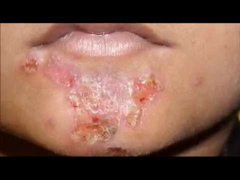 Beim Kind auf dem Bauch das Ekzem Die Schuppenflechte der Nägel der Beine die Symptome