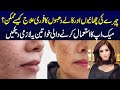 Easy Treatment For Spots On The Face Treatment Of Pigmentation Is Now Very Easy Dr Sahar Chawla