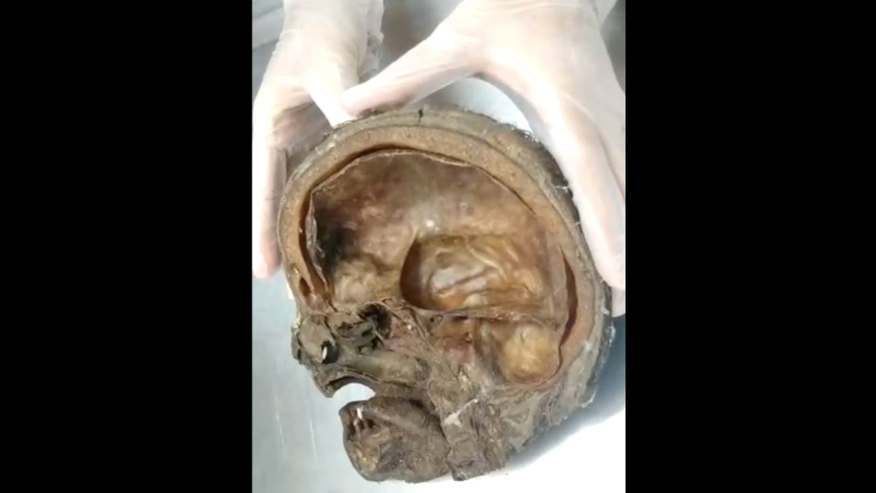 ANATOMIA GERAL - HEMI CABEÇA VERDADEIRA