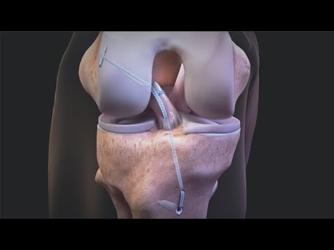 ACL Repair TightRope® Surgical Technique Animation