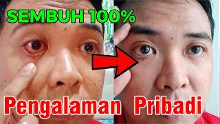 Download lagu Medicine for Red Eyes and Discharge - How to Treat Red Eyes mp3