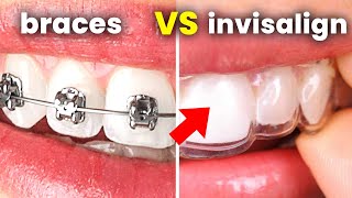 Invisalign vs Braces: what you NEED to ask your dentist...