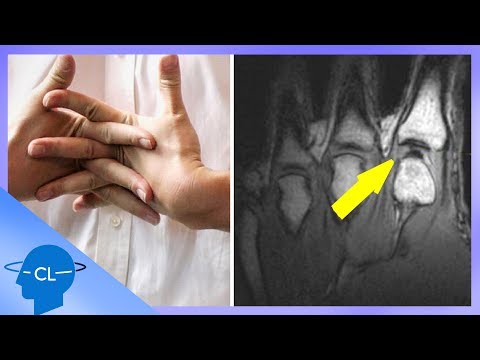 Cum să tratezi artrita și reumatismul