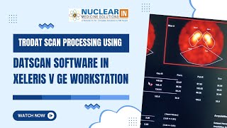 TRODAT Scan Processing Tutorial | DaTscan Analysis on Xeleris Workstation | GE NM Workflow Guide
