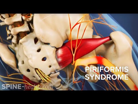 Piriformis-Syndrom