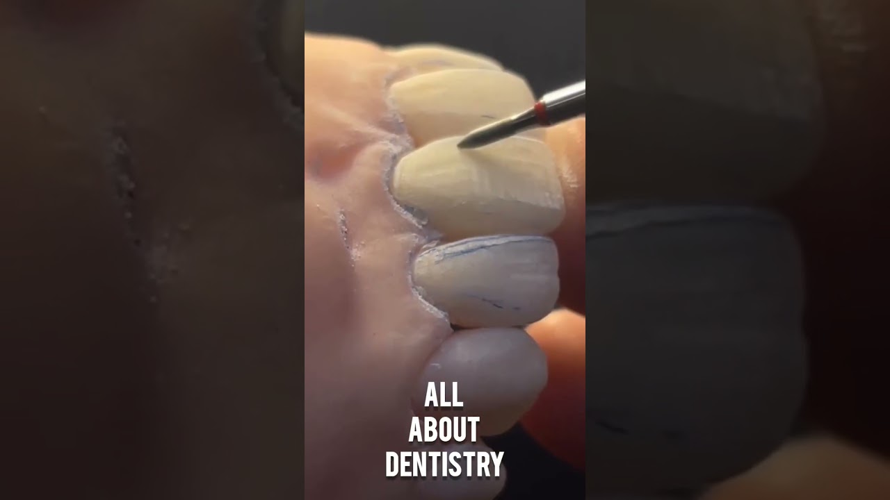 Dental motivation. Dental technical carving frontal teeth. Ceramic veneers #dentistry #dental