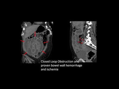 CT evaluation of bowel obstruction and Colitis